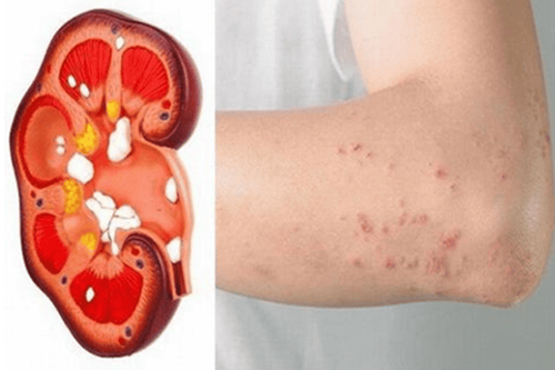 Dấu hiệu suy thận - Mệt mỏi, phù chân tay và cảm giác nặng người Dấu hiệu suy thận - Mệt mỏi, phù chân tay và cảm giác nặng người